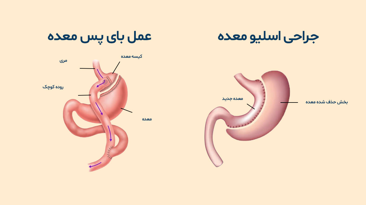 شماتیک برش های ایجاد شده در اسلیو و بای پس معده