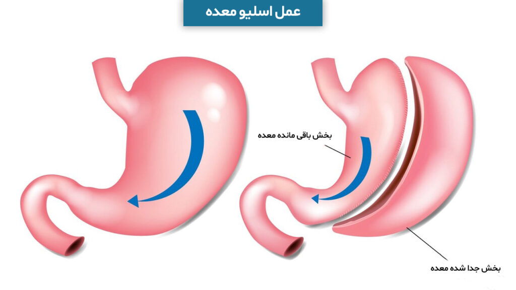 عمل اسلیو معده