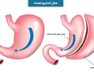 عمل اسلیو معده