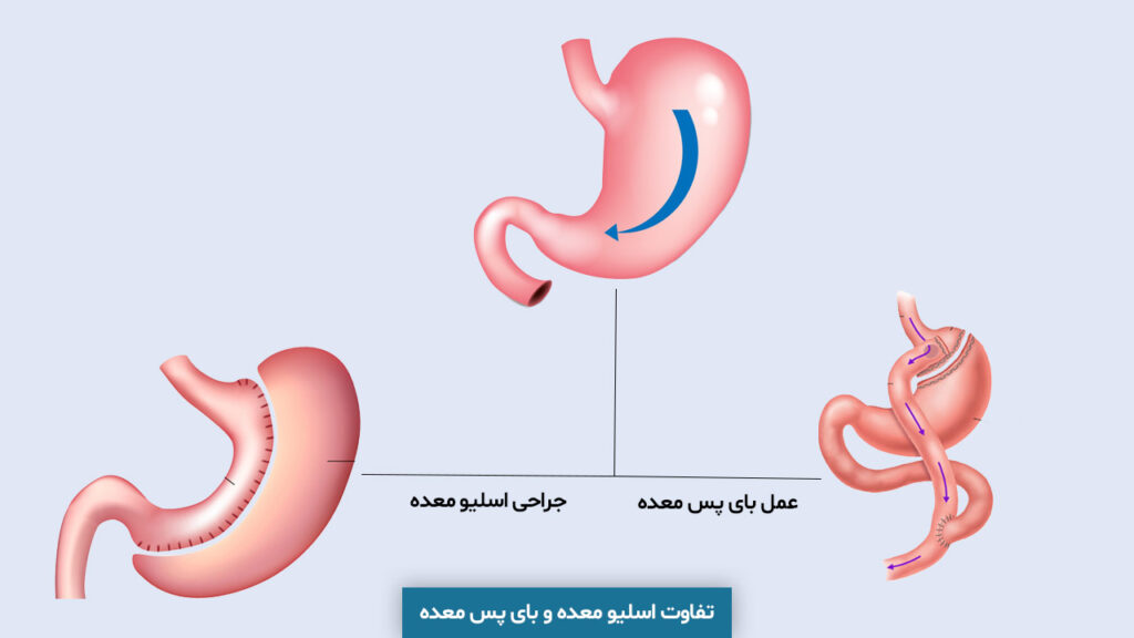 تفاوت اسلیو معده و بای پس معده