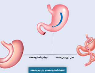 تفاوت اسلیو معده و بای پس معده