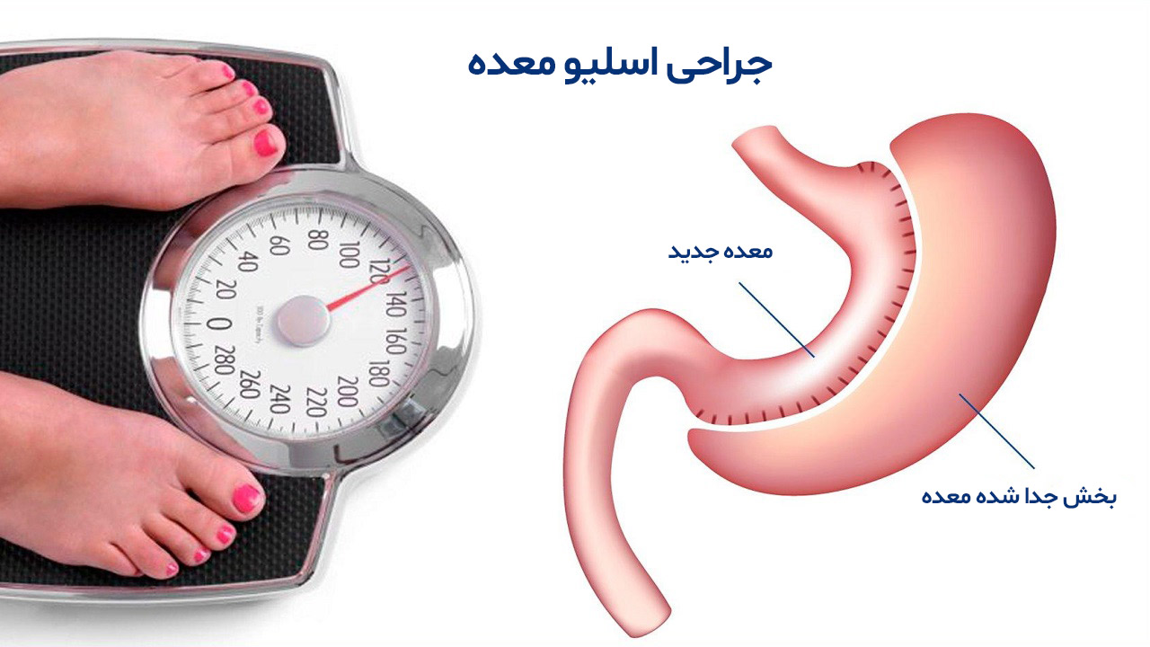 عمل اسلیو معده