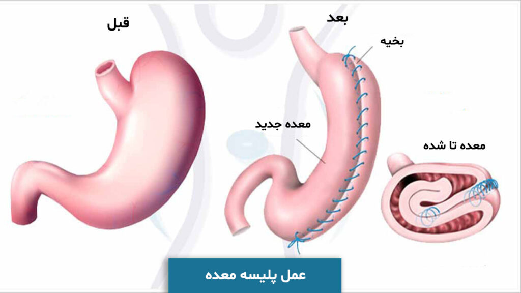 عمل پلیسه معده