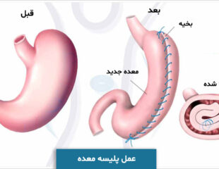 عمل پلیسه معده