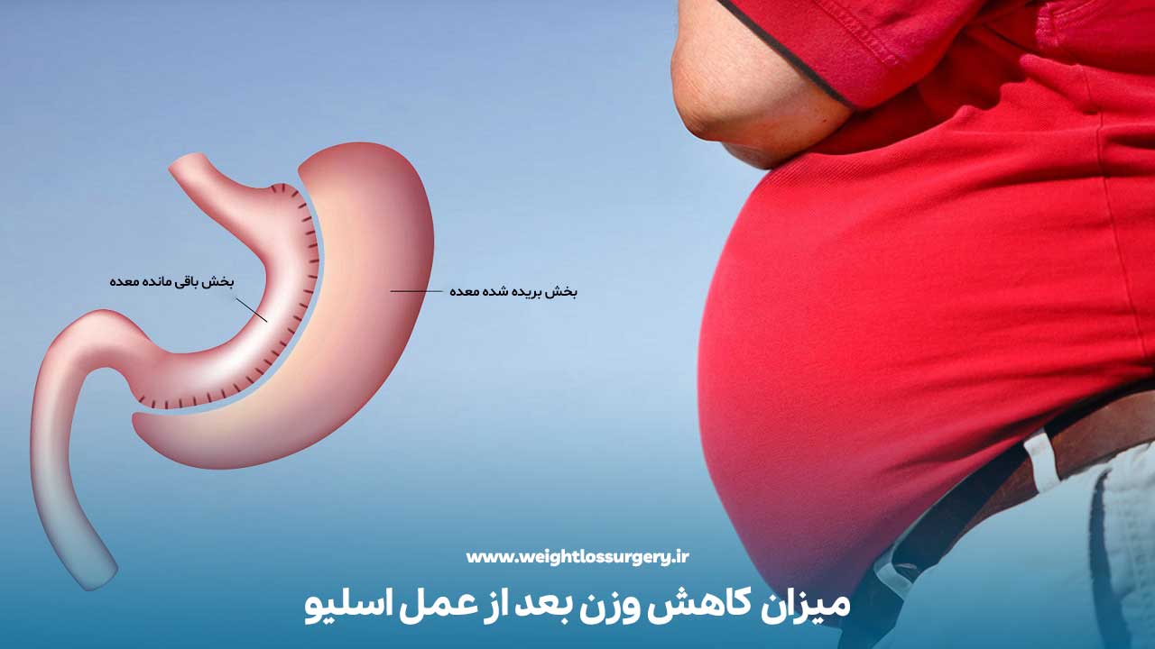 میزان کاهش وزن بعد از عمل اسلیو