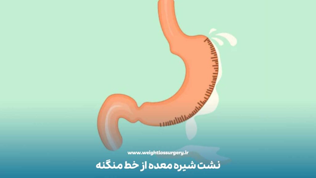 نشت شیره معده از خط منگنه