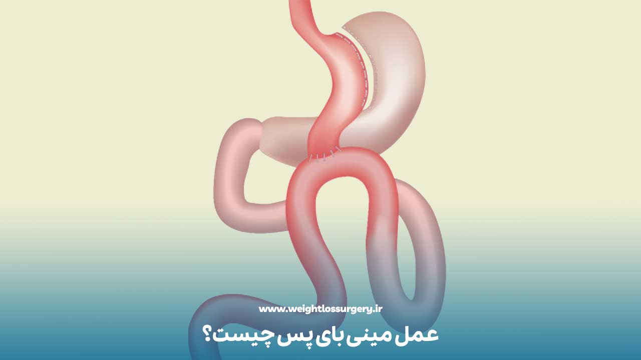 عمل مینی بای پس چیست؟