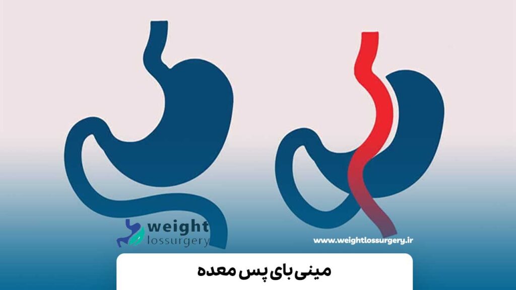 مینی بای پس معده