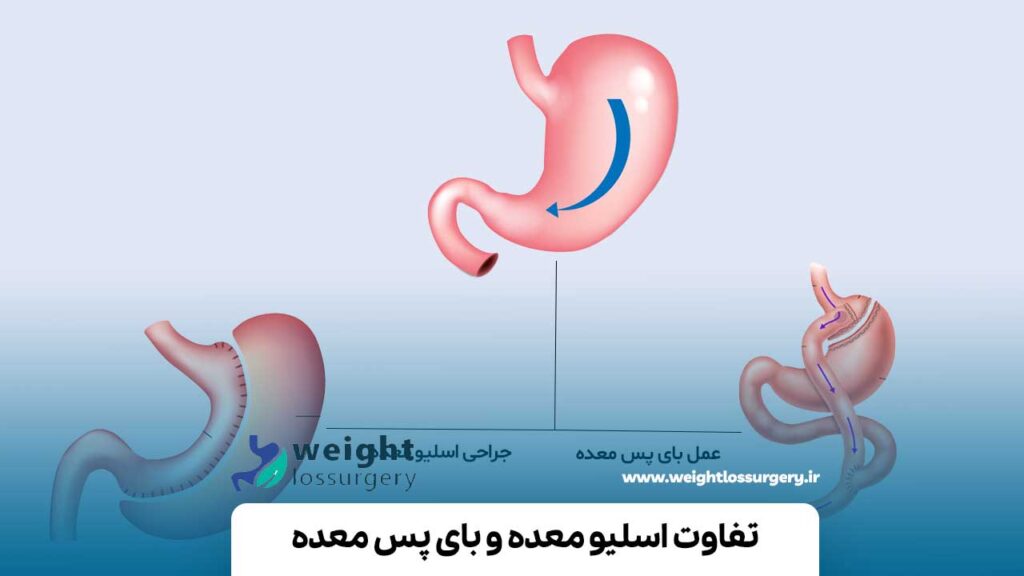 تفاوت اسلیو معده و بای پس معده