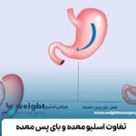 تفاوت اسلیو معده و بای پس معده