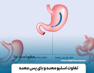 تفاوت اسلیو معده و بای پس معده
