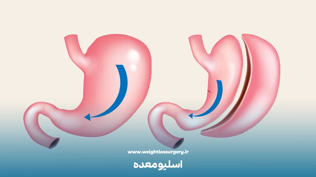 عمل اسلیو معده