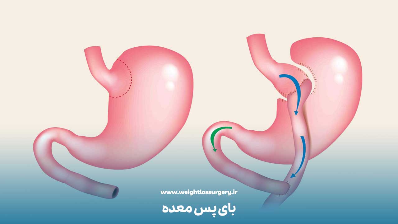 جراحی بای پس معده