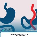 مینی بای پس معده