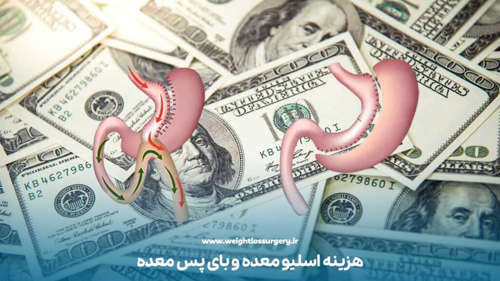 تفاوت اسلیو معده و بای پس معده از نظر هزینه