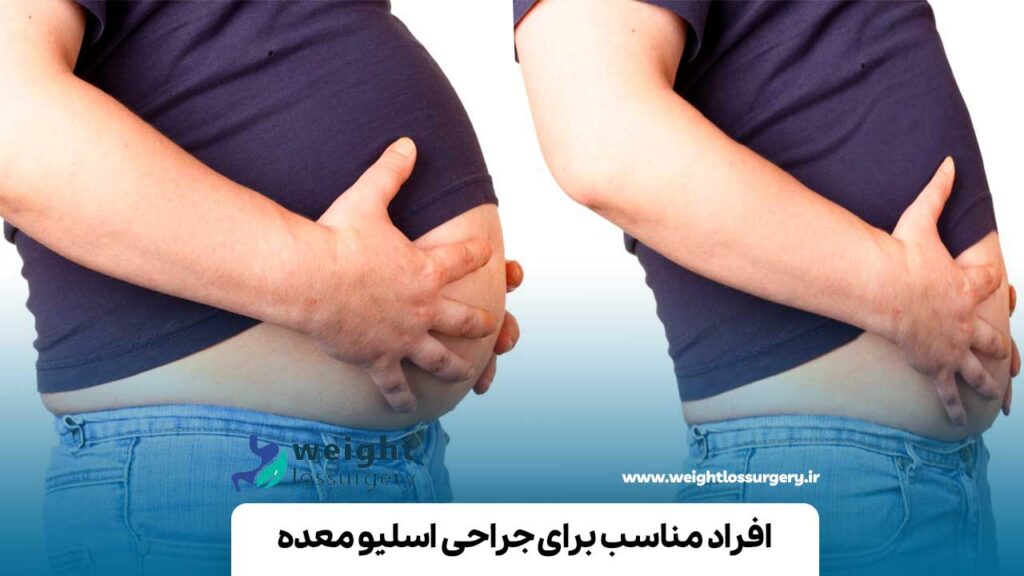 افراد مناسب برای جراحی اسلیو معده