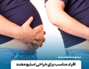 افراد مناسب برای جراحی اسلیو معده