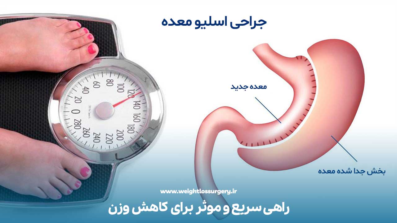 عمل اسلیو معده