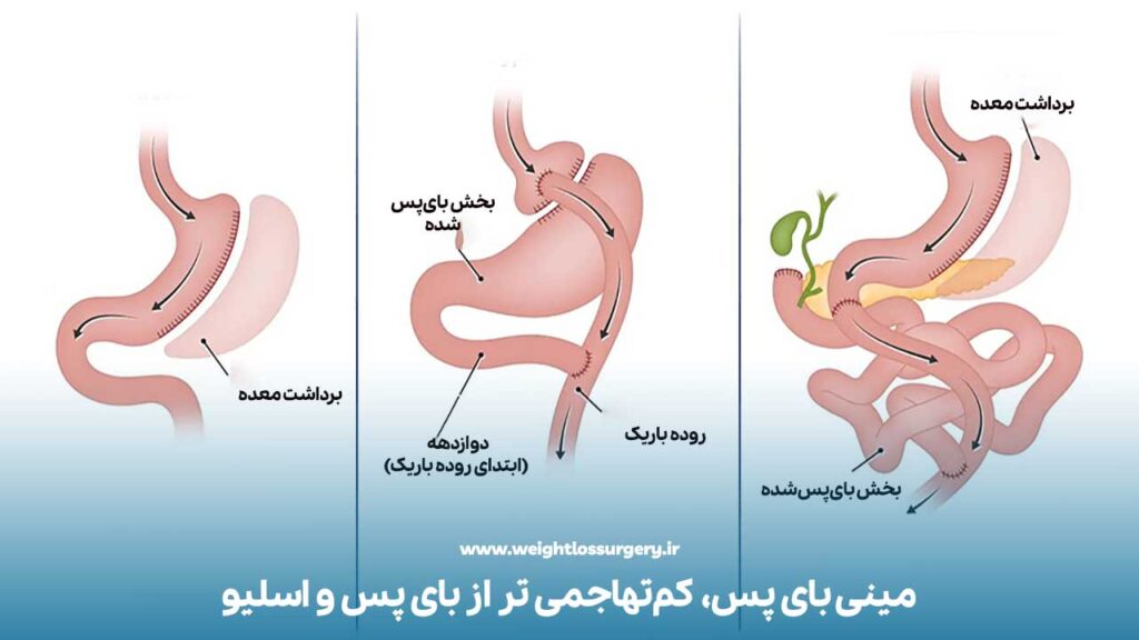 مینی بای پس؛ سریع‌تر و کم‌تهاجمی‌تر از بای پس و اسلیو
