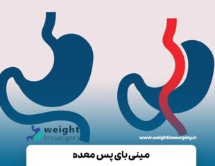 مینی بای پس معده