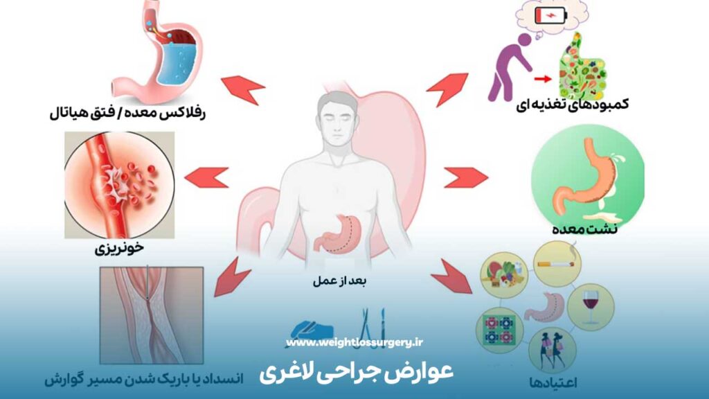 عوارض جراحی لاغری 