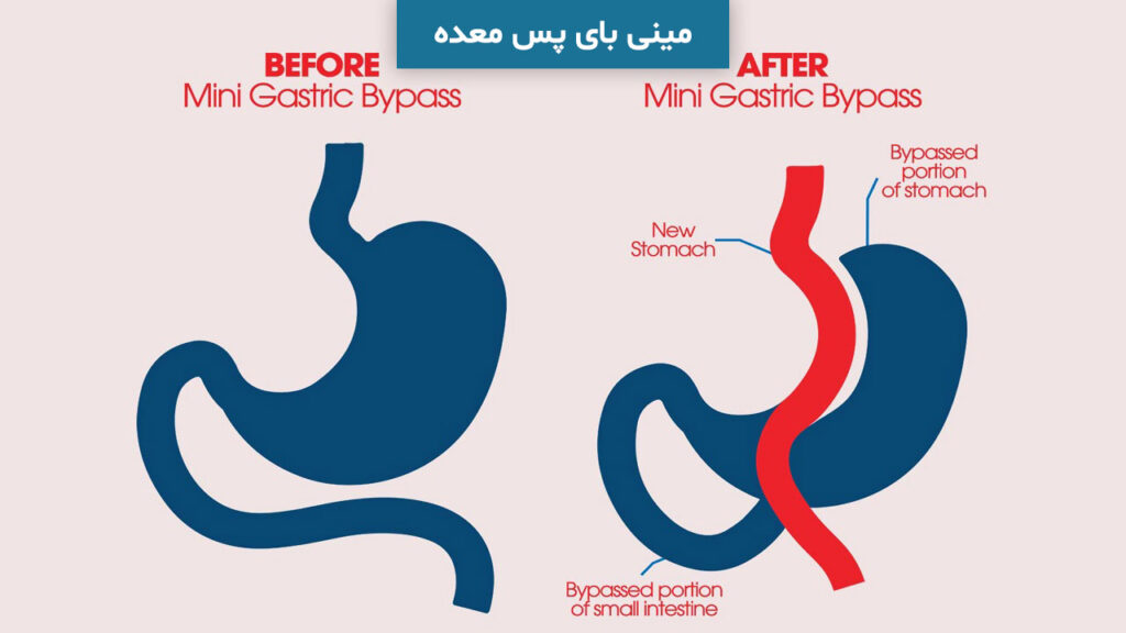 مینی بای پس