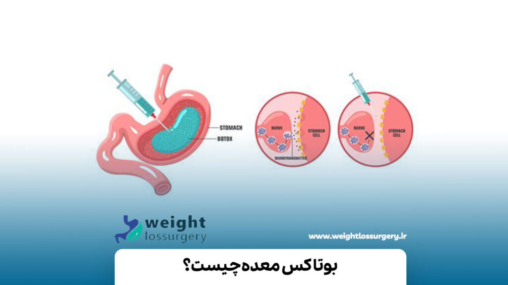 بوتاکس معده