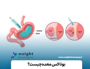 بوتاکس معده