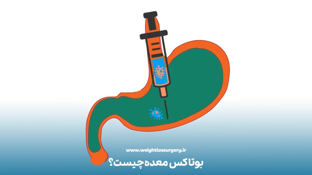بوتاکس معده چیست؟