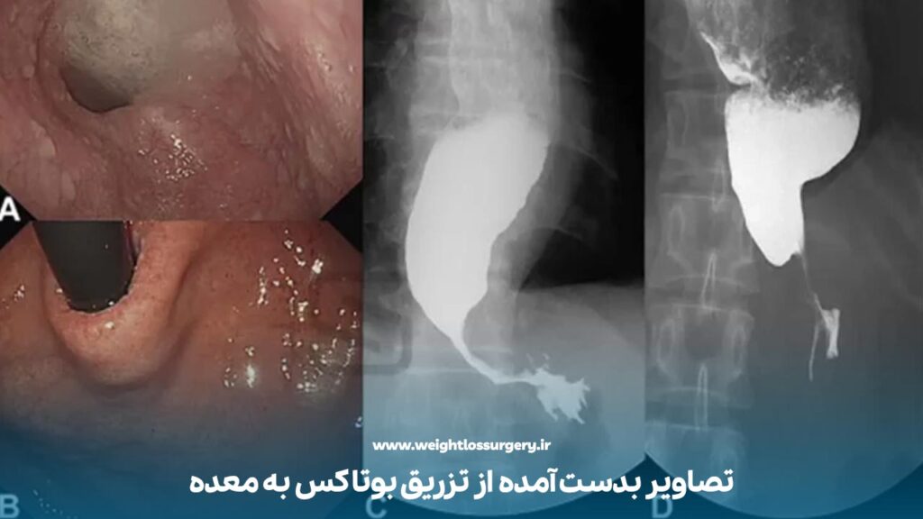 تصاویری از تزریق بوتاکس در معده