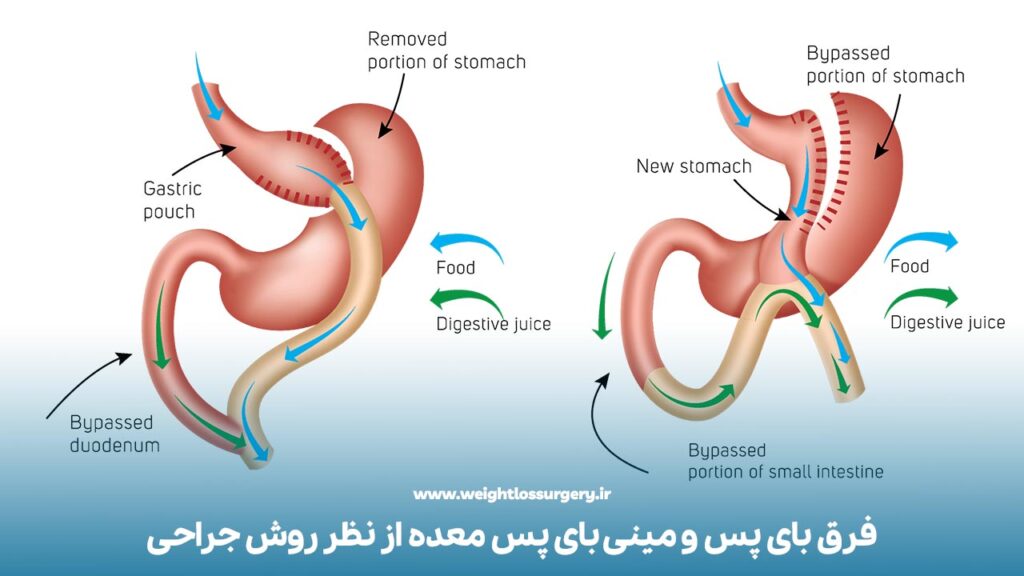 فرق بای پس و مینی بای پس معده از نظر روش جراحی