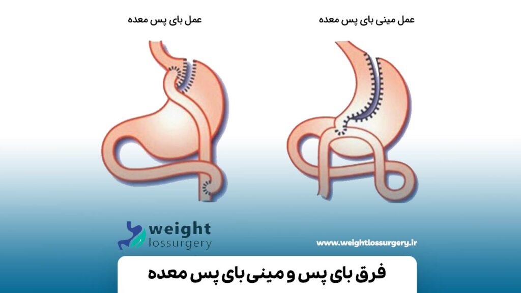 فرق بای پس و مینی بای پس معده