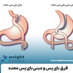 فرق بای پس و مینی بای پس معده