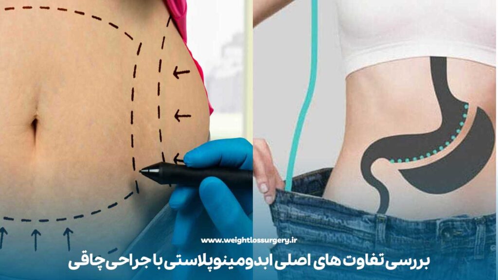 بررسی تفاوت های اصلی ابدومینوپلاستی با جراحی چاقی