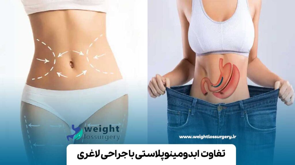 تفاوت ابدومینوپلاستی با جراحی لاغری
