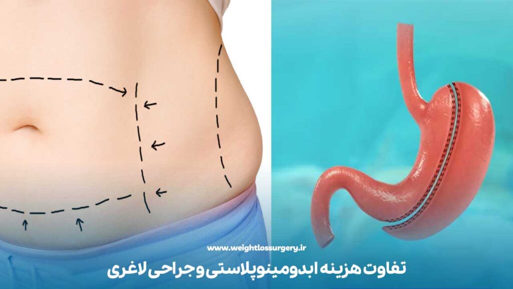 تفاوت هزینه ابدومینوپلاستی و جراحی لاغری