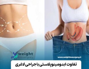 تفاوت ابدومینوپلاستی با جراحی لاغری