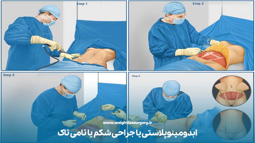 ابدومینوپلاستی چیست