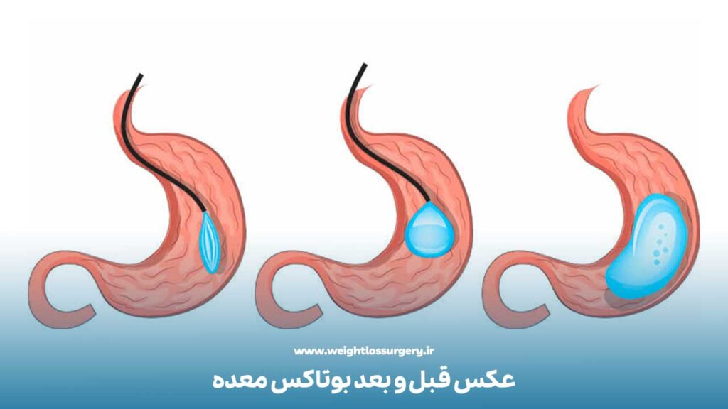 عکس قبل و بعد بوتاکس معده