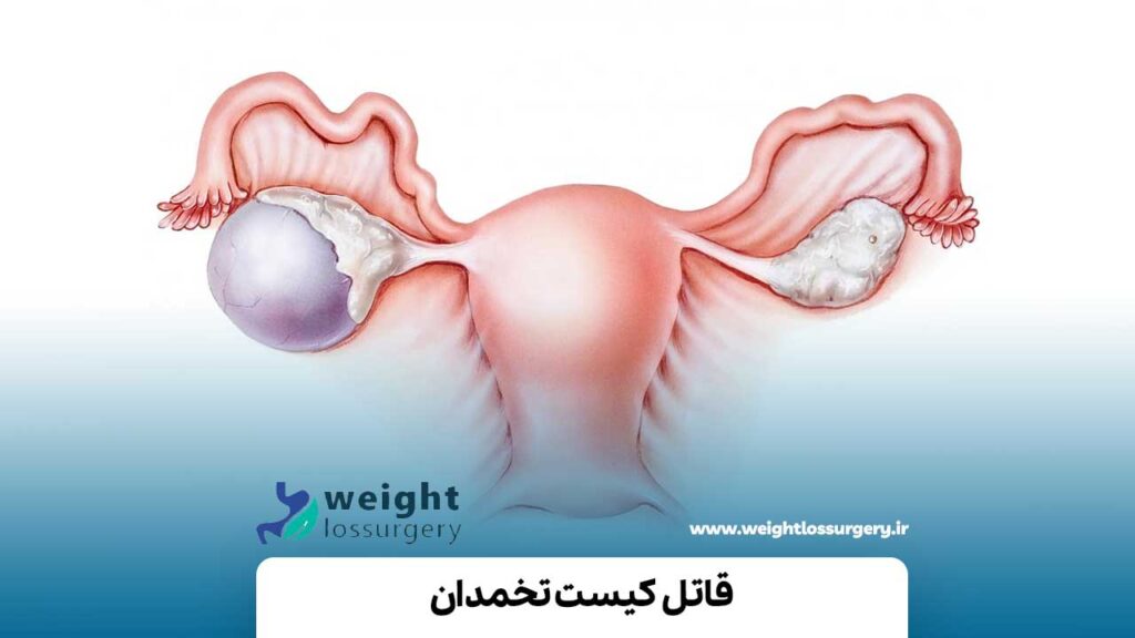 قاتل کیست تخمدان