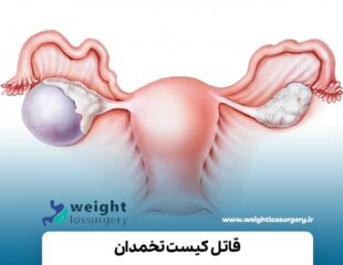 قاتل کیست تخمدان