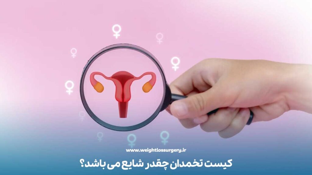 کیست تخمدان چقدر شایع می باشد؟