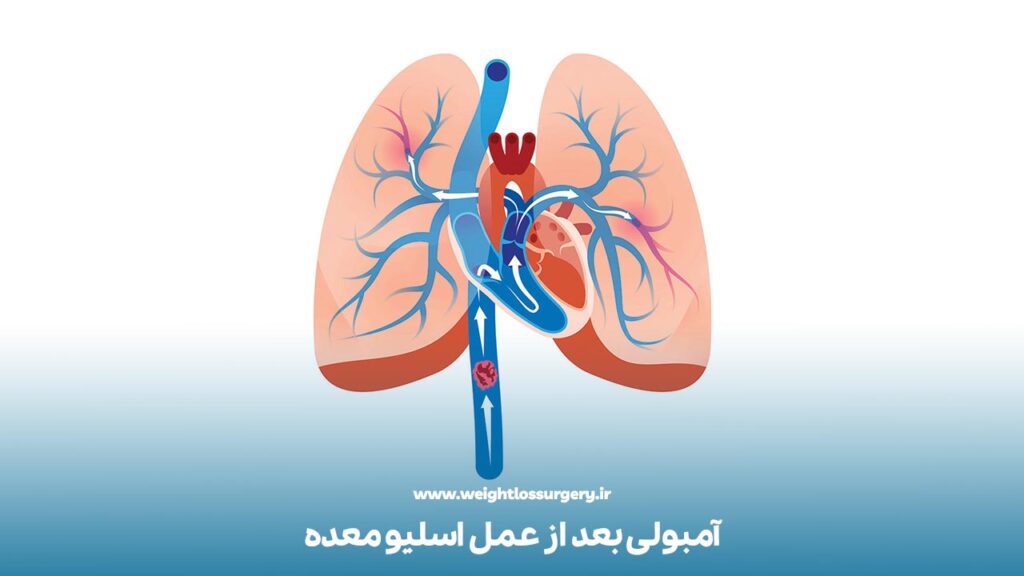 آموبلی بعد از عمل اسلیو معده