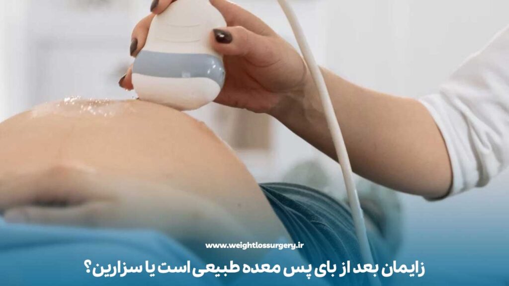 زایمان بعد از بای پس معده طبیعی است یا سزارین؟