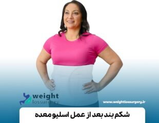 شکم بند بعد از عمل اسلیو معده
