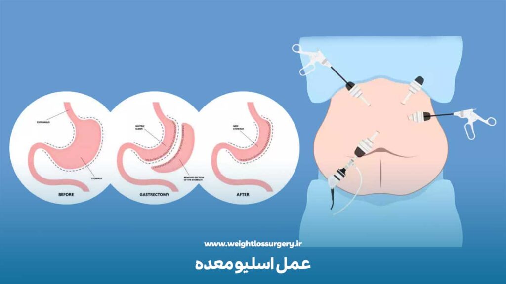 عمل اسلیو معده