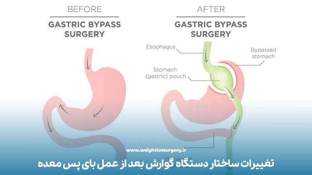 تغییرات ساختار دستگاه گوارش بعد از عمل بای پس معده