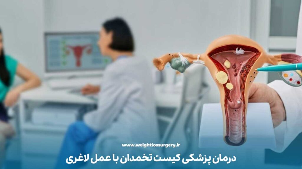 درمان پزشکی کیست تخمدان با عمل لاغری