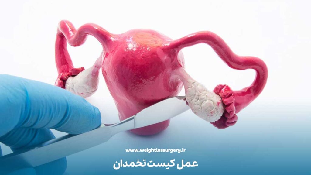 عمل کیست تخمدان