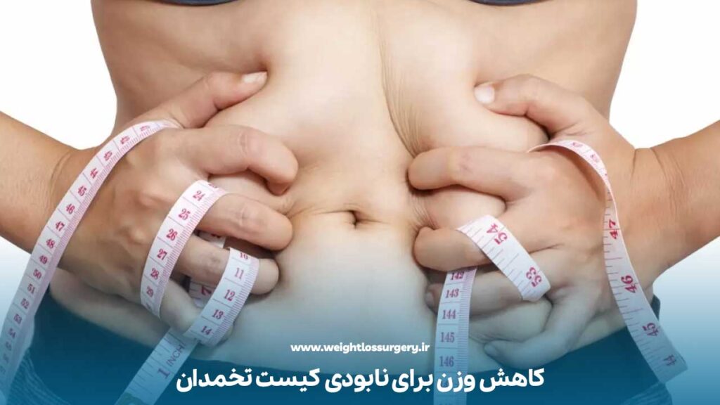 کاهش وزن برای نابودی کیست تخمدان